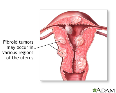 Utero ingrossato: cause, sintomi e soluzioni